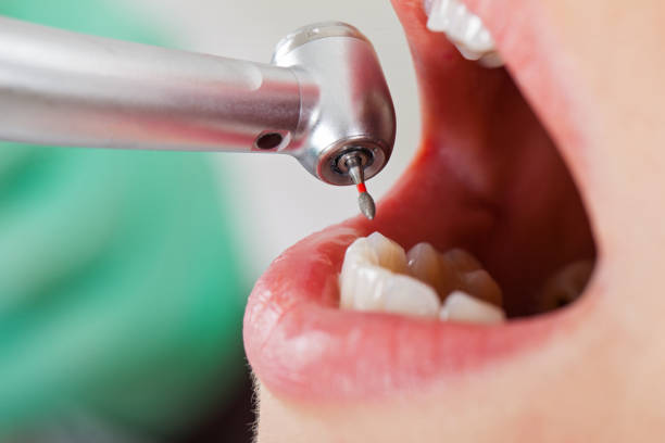 Best Lost Filling or Crown Replacement in Mesilla, NM